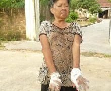 Bị đốt hai bàn tay vì bẻ cây trong vườn