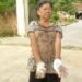 Bị đốt hai bàn tay vì bẻ cây trong vườn